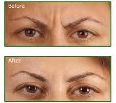 botox before and after