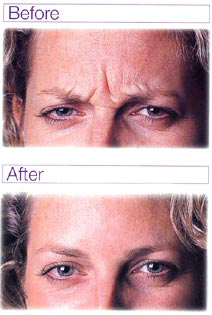 botox before and after