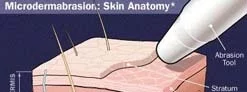Microdermabrasion for Stretch Mark Removal