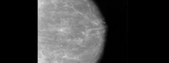 Mammogram Interpretation